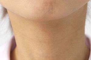 実はかなり難しいボトックス注射